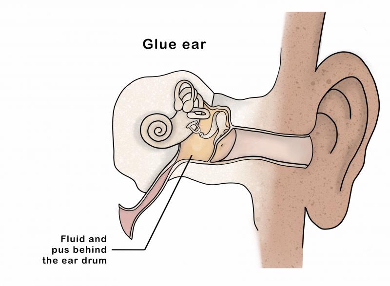 Glue Ear Kidshealth Nz